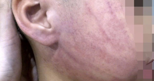 Điều tra vụ bé 4 tuổi nghi bị giáo viên mầm non đánh bầm tím mặt