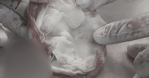 Người phụ nữ ôm ngực thủng lỗ như "hố giếng" đi cấp cứu: Bác sĩ sốc khi phát hiện vật bị bỏ quên bên trong