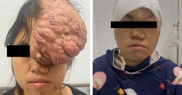 Ngỡ ngàng khuôn mặt cô gái sau 15 năm bị khối u khổng lồ đeo bám
