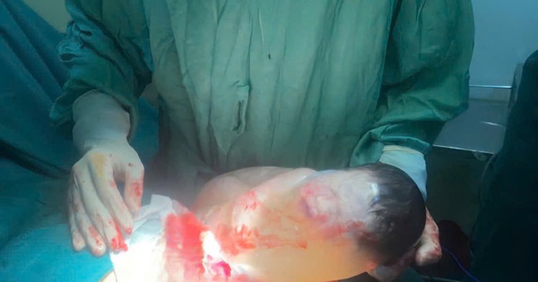 Khoảnh khắc hiếm gặp: Trẻ sơ sinh chào đời còn nguyên trong bọc ối