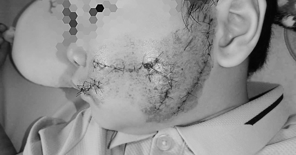 Cháu bé 5 tuổi ở Bắc Ninh bị chó cắn rách toang mặt khi đang chơi tại sân nhà