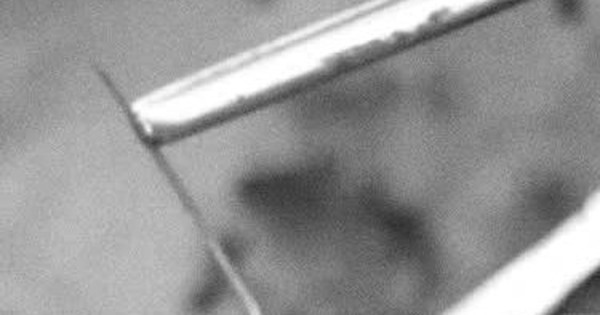 Ăn bún cá, người đàn ông 33 tuổi ở Phú Thọ bị xương cá 4cm xuyên thủng ruột non