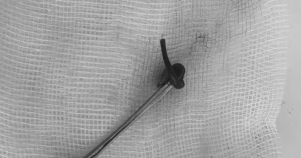 Cô gái 21 tuổi đau nhói ở mũi, bác sĩ gắp ra "thứ đáng sợ" bên trong