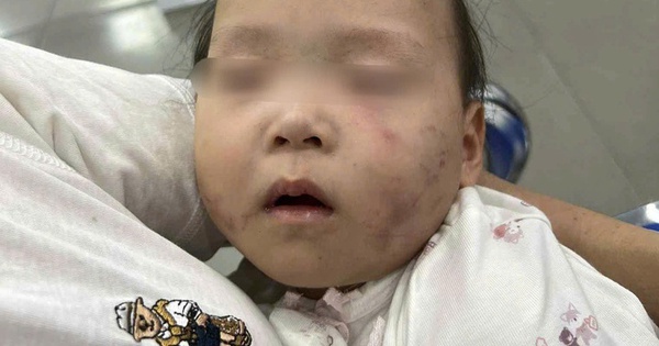Làm rõ nguyên nhân bé gái bị bầm tím mặt khi gửi ở nhà trẻ Bắc Ninh