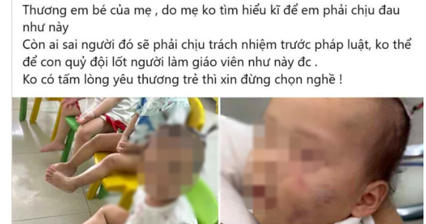 Bé gái bị bầm tím mặt sau khoảng 7 tiếng ở nhà trẻ tư thục: Tình trạng sức khoẻ hiện tại