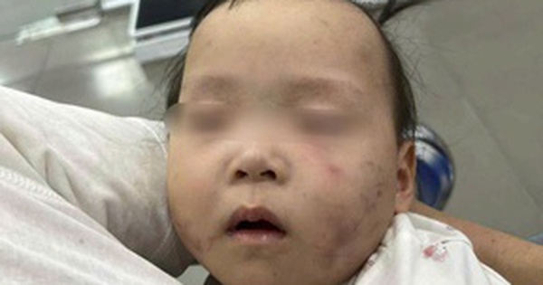 Bé gái 1 tuổi bị bầm tím mặt khi gửi nhà trẻ ở Bắc Ninh: Công an tạm giữ cô giáo