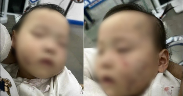 Vụ bé gái bầm tím mặt, có vết răng cắn sau khi đi học mầm non tư thục: Thông tin bất ngờ về cô giáo