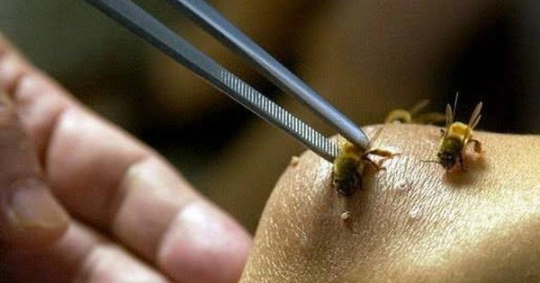 Vụ mẹ tử vong, con 3 tuổi nhập viện do bị ong vò vẽ đốt: Người mẹ lấy thân che chắn cho con, chịu đến 200 vết đốt