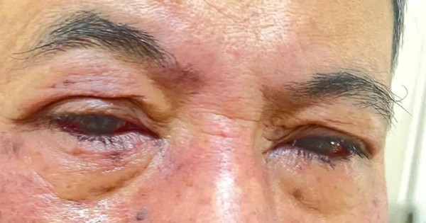 Cảnh báo tổn thương mắt do dị ứng thuốc