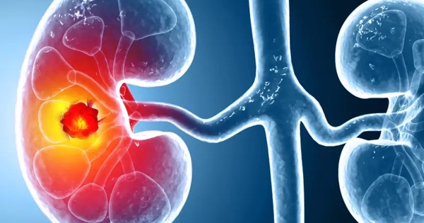Số ca mắc ung thư thận gia tăng trên toàn cầu: Ở giai đoạn sớm hay muộn đều có 3 dấu hiệu này
