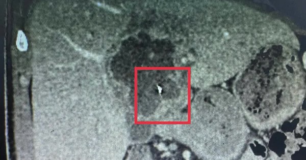 Ca bệnh hiếm gặp: Nội soi lấy dị vật kim loại trong gan