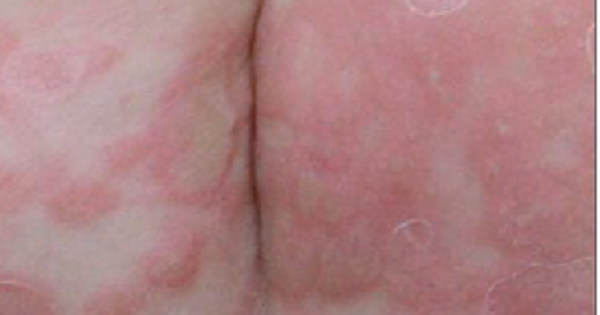 Bé trai 3 tuổi mắc giang mai bẩm sinh do bố mẹ điều trị không đúng phác đồ