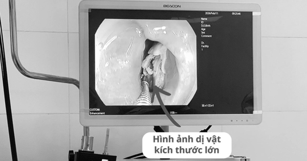 Bệnh nhân 16 tuổi đau họng kéo dài, bác sĩ phát biện bí mật "đáng sợ" bên trong