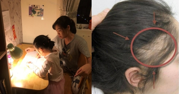 Thức khuya kèm con học, mẹ rụng tóc đến hói cả đầu!