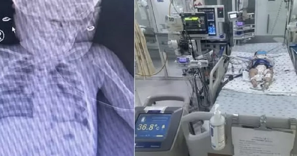 Bé gái mới biết đi bị ngã vào thùng nước khiến ngưng tim ngưng thở