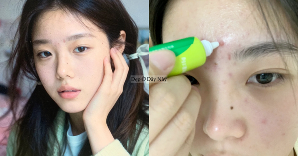 5 lọ kem chấm mụn 