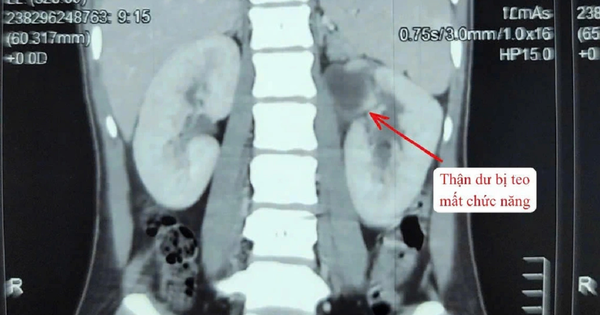 Kỳ lạ cô gái 22 tuổi có 3 quả thận
