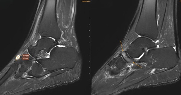 4 thói quen âm thầm ''ăn mòn'' xương ở người trên 40 tuổi