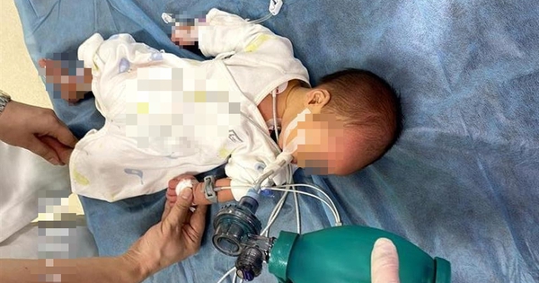 Em bé 52 ngày tuổi ngộ độc Botulinum nguy kịch vì loại nước chữa ho, bổ phổi rất quen từ bà ngoại