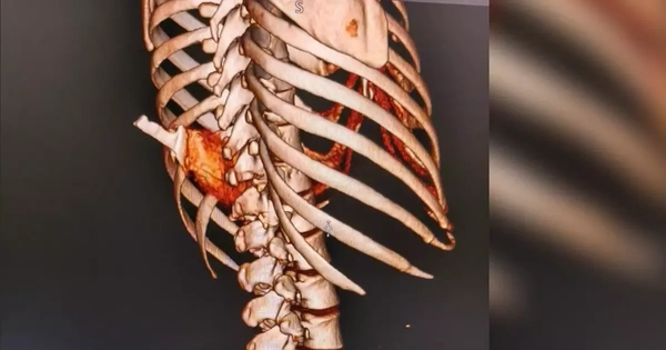 Người phụ nữ nhập viện với con dao Thái Lan cắm trên lưng