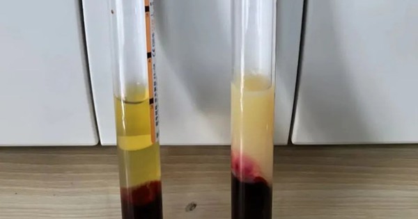 Vì sao tôi luôn kiểm soát mỡ máu nhưng khi khám lại vẫn không cải thiện, thậm chí bị nặng hơn?