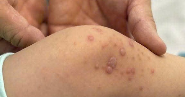 Bệnh tay chân miệng tăng nhanh, bác sĩ cảnh báo nóng
