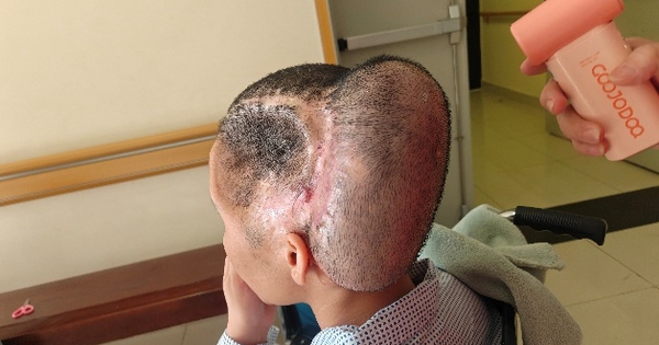 Đột quỵ sau hút mỡ làm đẹp