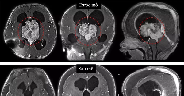 Bé sơ sinh bị u não, bác sĩ cảnh báo dấu hiệu cần nhập viện ngay
