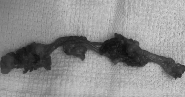 Đau âm ỉ vùng bụng, người đàn ông sốc nặng khi bác sĩ lấy ra thứ 