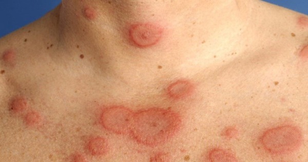 Căn bệnh nguy hiểm chỉ 10% được chẩn đoán sớm, có người vài năm mới phát hiện