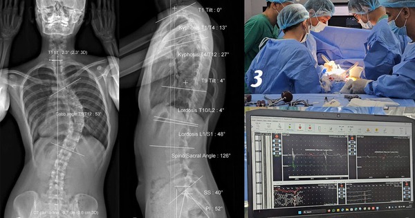 Cô gái soi gương thấy lưng có dấu hiệu lạ, không ngờ cột sống đã cong 53 độ
