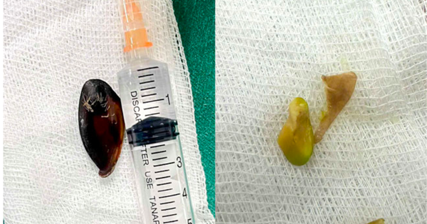 Bé 14 tuổi ho khan kéo dài, gia đình sốc khi bác sĩ lấy ra dị vật bên trong cơ thể