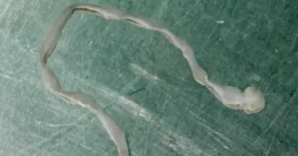 Người phụ nữ lên cơn co giật, bác sĩ lấy ra thứ đáng sợ trong não