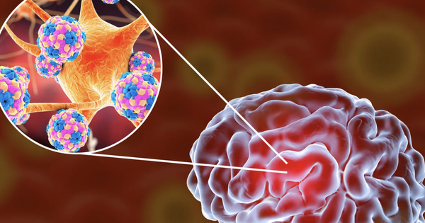 Bệnh nhi 2 tuổi bị viêm não mô cầu đã không qua khỏi