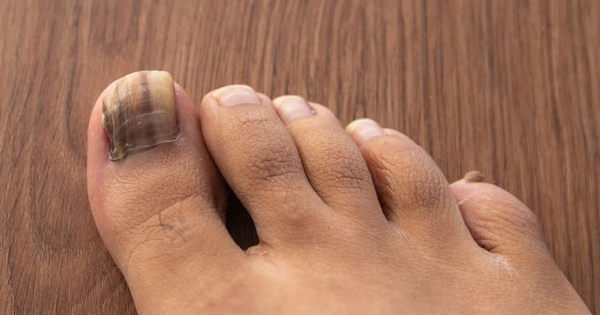 Dấu hiệu ở móng chân cảnh báo loại ung thư nguy hiểm: Nhiều người bỏ qua, bác sĩ khẩn thiết nhắc nhở