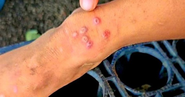 Thái Lan bật cảnh báo khi 23 người tử vong, 732 người bị lây nhiễm 1 căn bệnh, ở Việt Nam cũng đã xuất hiện