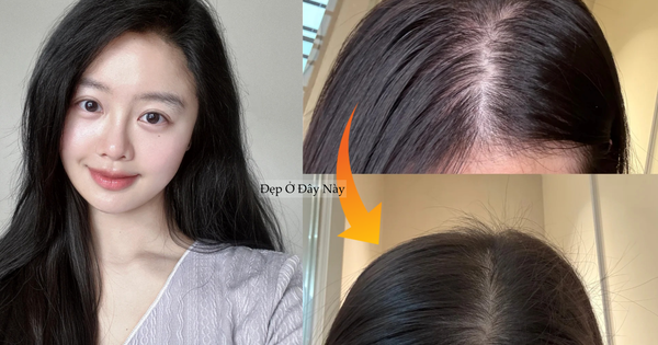 Tóc rụng đến nỗi lộ cả mảng da đầu, tôi quyết định theo 5 quy tắc chăm sóc sau để tóc đen dày trở lại