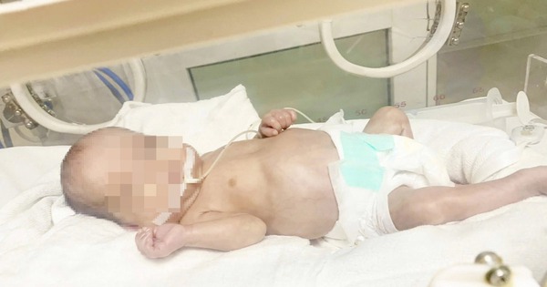 120 ngày giành giật sự sống cho bé sinh non 500gr phải thở máy kéo dài