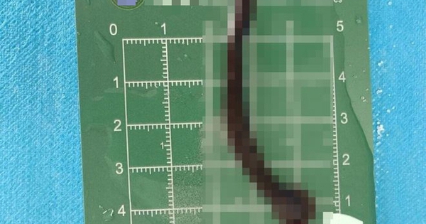 Bé trai 8 tuổi ho ra máu suốt 10 ngày, bác sĩ gắp được 