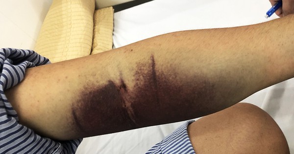 Gần 32.000 ca mắc, 4 ca tử vong: Bệnh viện Bạch Mai phát cảnh báo về 1 căn bệnh đang tăng nhanh, có thể suy đa tạng chỉ trong vài ngày