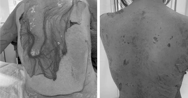 Hải Phòng: 1 phụ nữ 35 tuổi bị tróc da như 