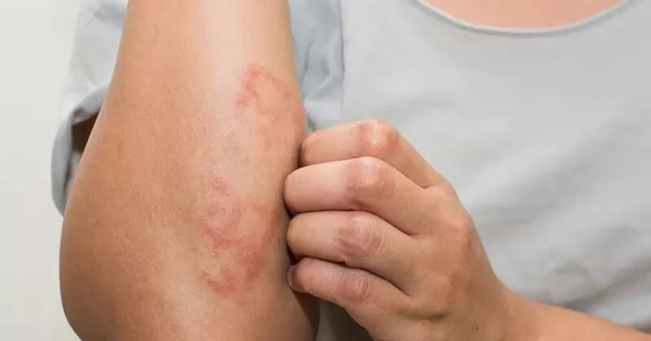 Nổi mẩn tưởng dị ứng thông thường, trẻ gặp nguy cơ tổn thương thận