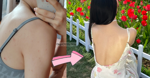 Cô nàng này áp dụng đúng 3 bước để làm sạch mụn lưng, tha hồ diện đồ hở mùa hè