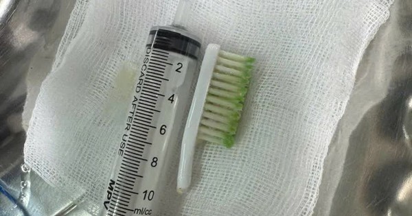 Gắp thành công bàn chải đánh răng trong dạ dày bệnh nhân