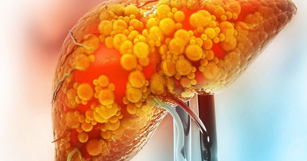 5 “thủ phạm” khiến gan ngập trong mỡ: Ít ai ngờ tới