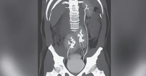 Đi khám nhiễm trùng tiết niệu, người đàn ông 31 tuổi phát hiện có 3 quả thận