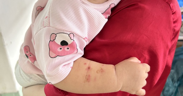 Nhiều ca tay chân miệng nặng tái nhiễm, bác sĩ kỳ vọng sớm có vaccine