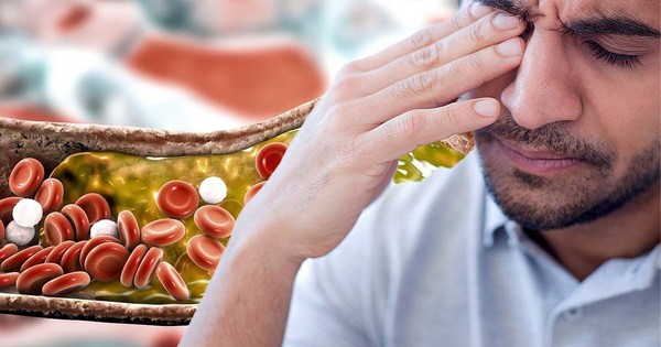 Nhìn vào mặt cũng có thể biết mỡ máu cao hay không: Nếu thấy 2 dấu hiệu này, hãy đi khám ngay