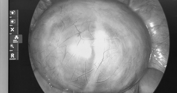 Đau bụng tưởng nhẹ, người phụ nữ sốc nặng khi bác sĩ lấy ra thứ “rợn người” trong cơ thể