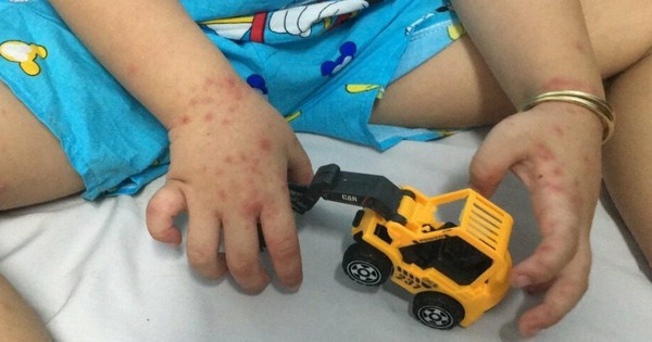 Sốt xuất huyết, tay chân miệng tăng trong tháng 4